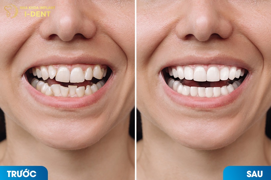 Khớp cắn được điều chỉnh chuẩn giúp cơ mặt thư giãn và gương mặt cân đối hơn.