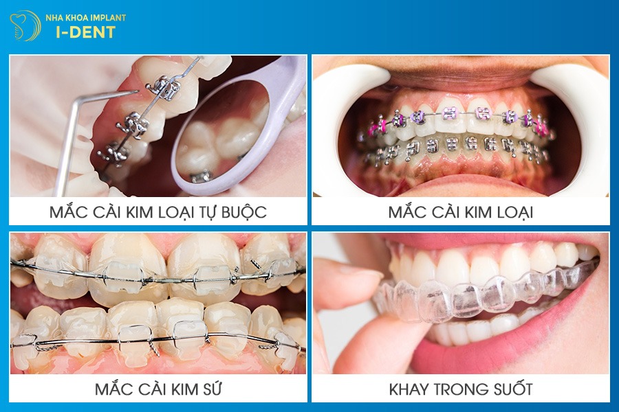 40 tuổi có niềng răng được không