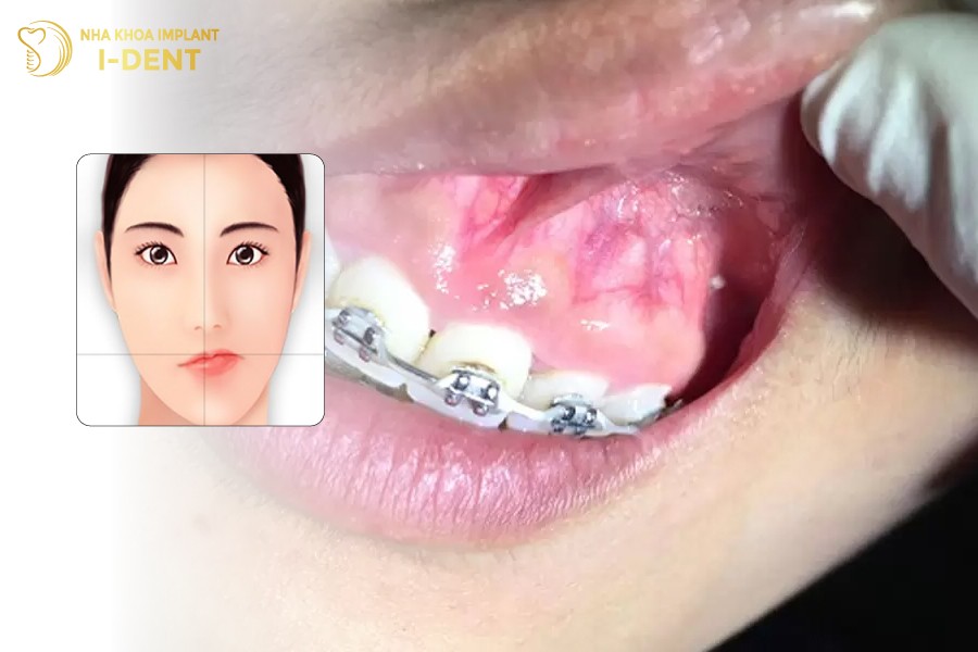 niềng răng mặt lệch