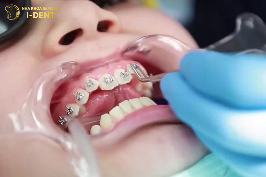 Bac-si-nieng-rang-tay-nghe-kem-dan-toi-tinh-trang-viem-loi-dau-nhuc.