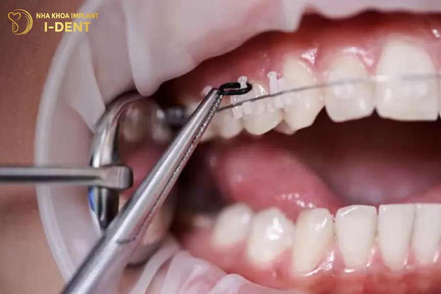 Bac-si-tien-hanh-gan-cac-khi-cu-len-rang-de-bat-dau-qua-trinh-chinh-nha