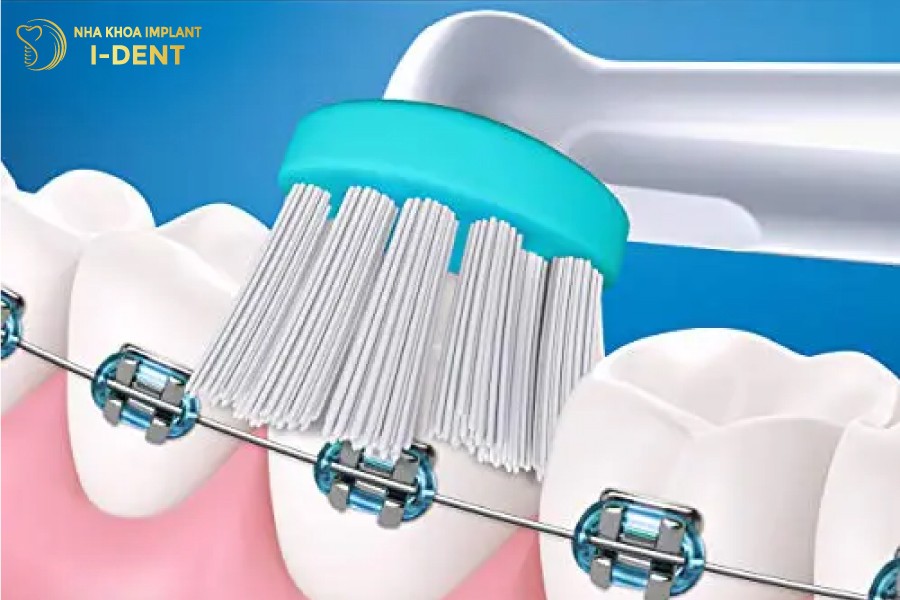 Bàn chải điện giúp làm sạch răng niềng dễ dàng hơn