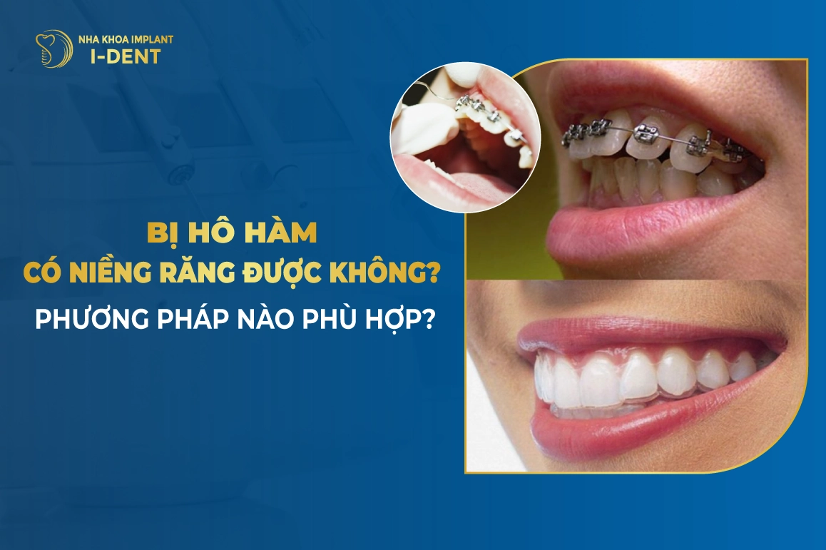 Bị Hô Hàm Trên Có Niềng Răng Được Không?