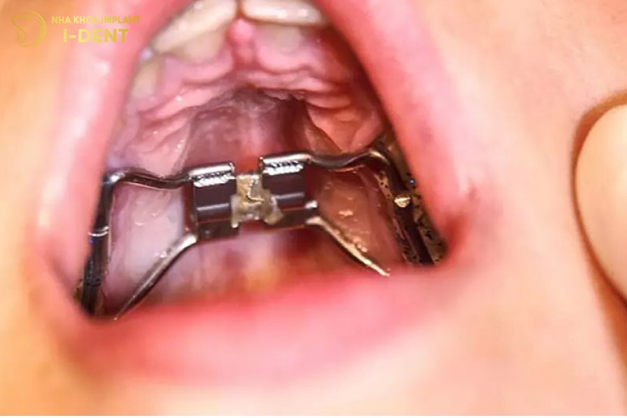 Cac-truong-hop-can-nong-ham