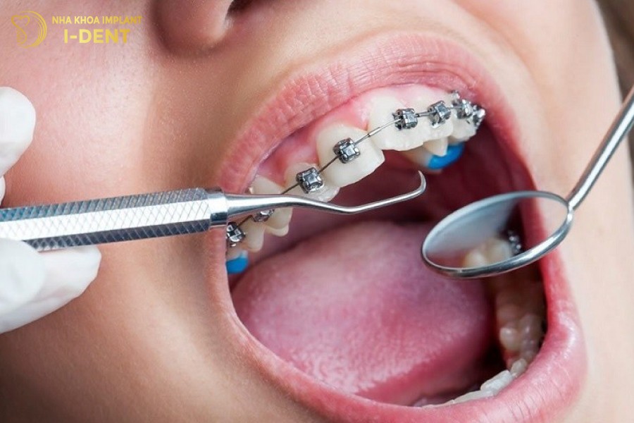 Thời gian niềng của mỗi người sẽ khác nhau tùy thuộc vào rất nhiều yếu tố