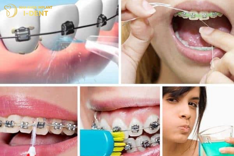 Chăm sóc răng miệng kỹ lưỡng để hạn chế răng chạy lại sau khi tháo niềng