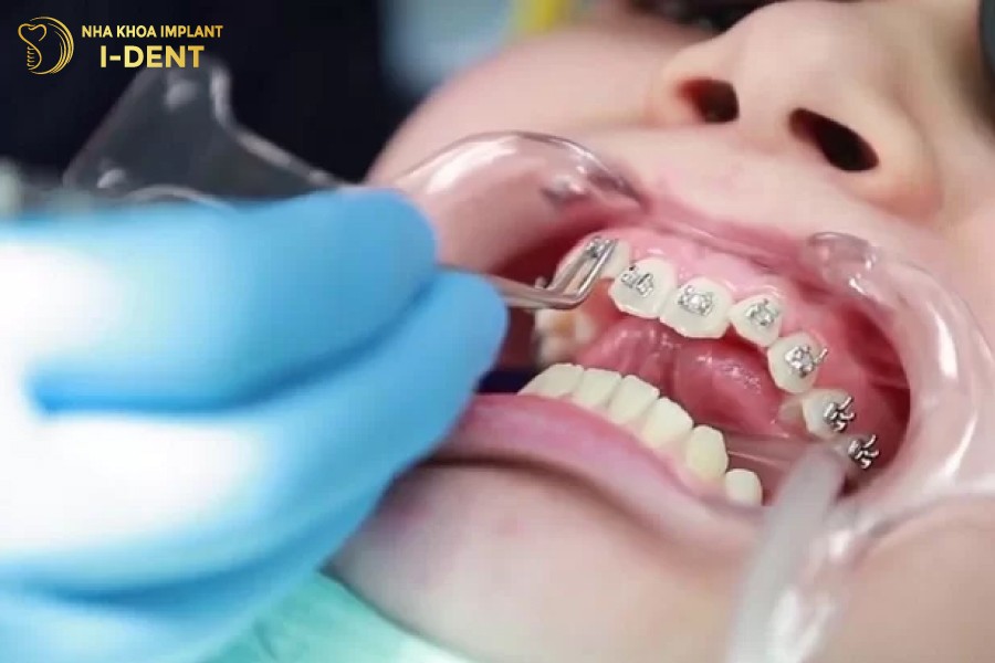 Chon-bac-si-nieng-rang-gioi