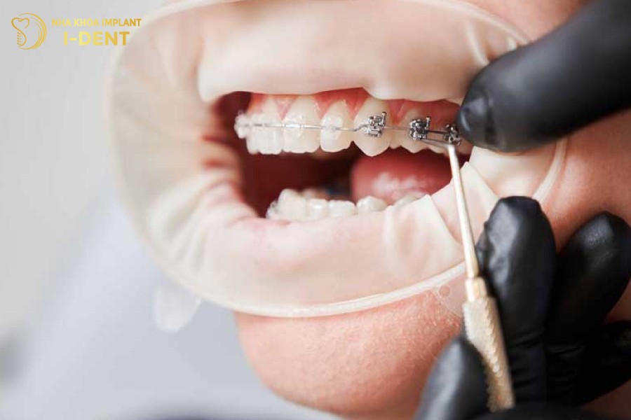 Chon-nha-khoa-uy-tin-giup-han-che-nhung-bien-chung