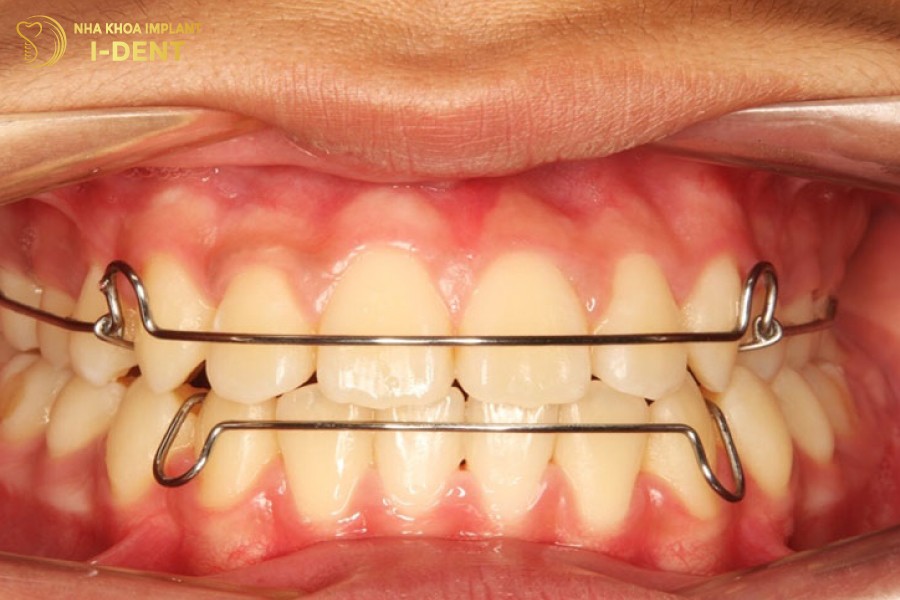 Đeo hàm duy trì đúng cách để giữ răng không bị dịch chuyển