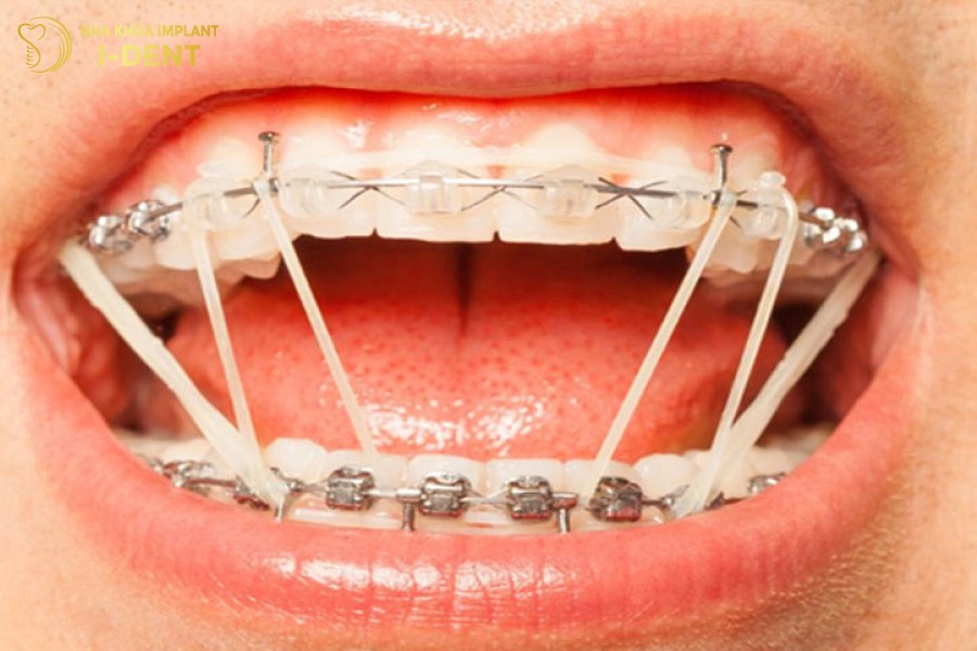 bộ niềng răng