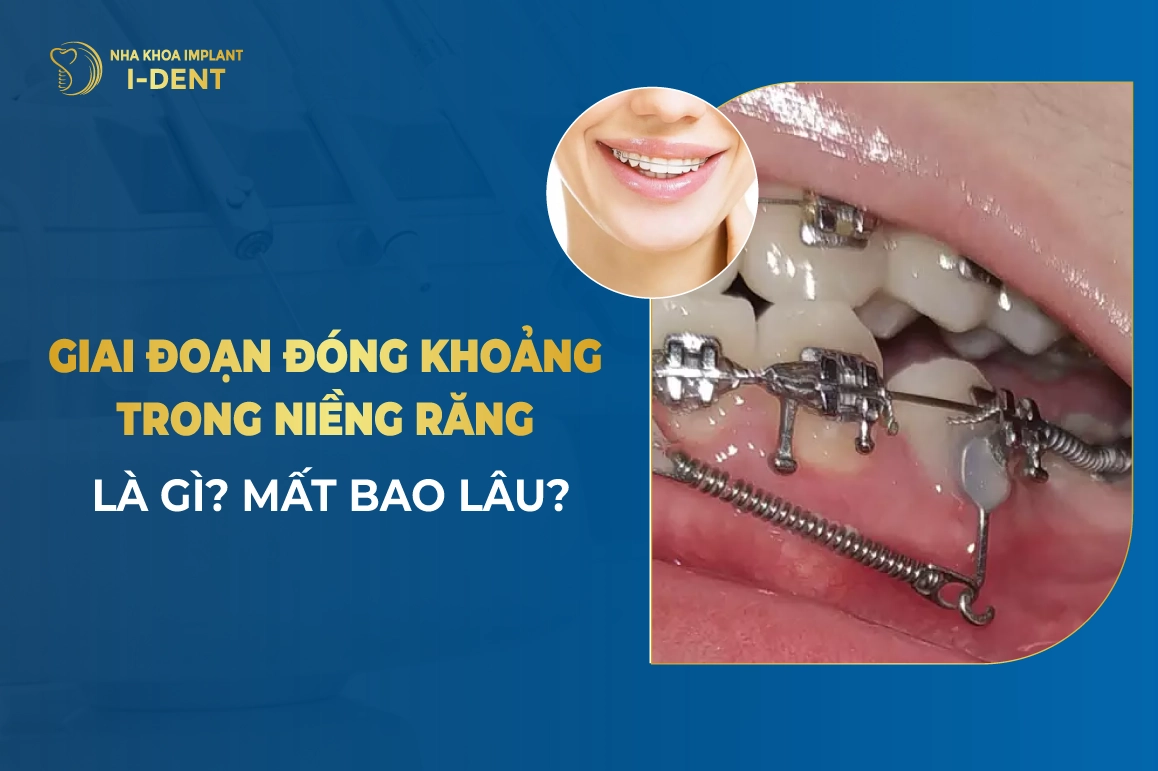 Giai Đoạn Đóng Khoảng Trong Niềng Răng Là Gì? Mất Bao Lâu?