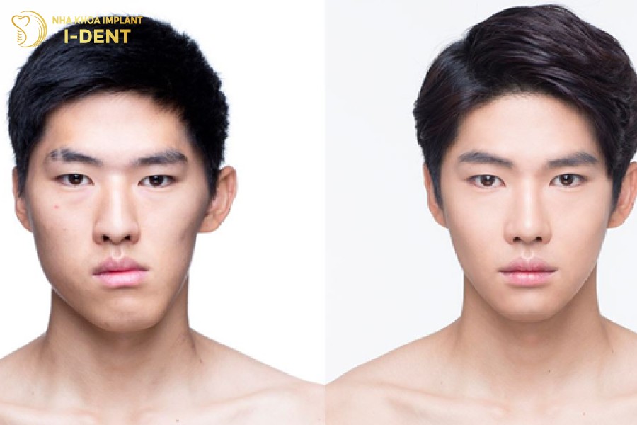 Giai-doan-dong-khoang-trong-nieng-rang