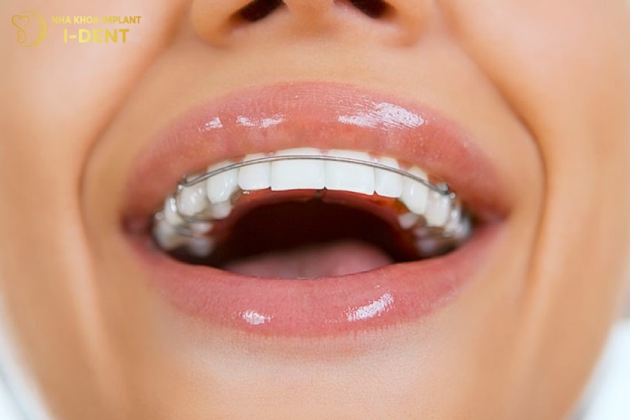 niềng răng có bị lệch mặt không