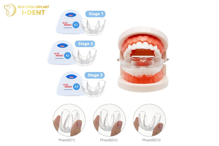 niềng răng tại nhà trainer có hiệu quả không