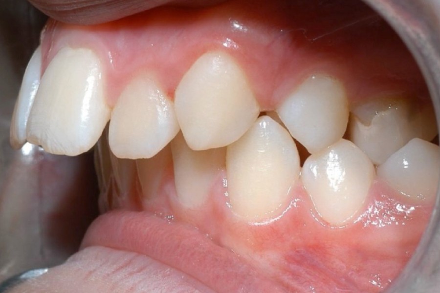 Hinh-anh-vau-do-rang-va-xuong-ham