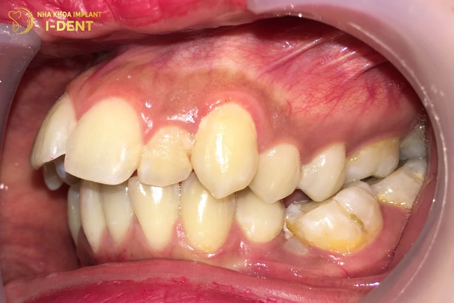 Hinh-anh-vau-do-rang