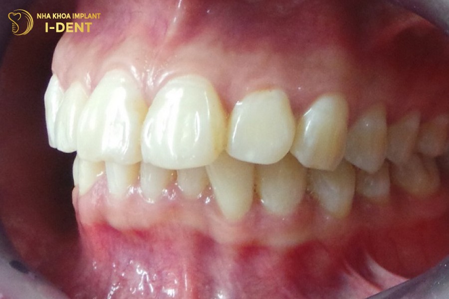 Hinh-anh-vau-do-xuong-ham