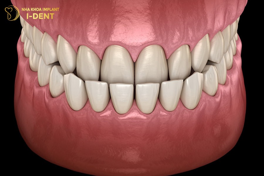 Hinh-dang-rang-khop-can-nguoc