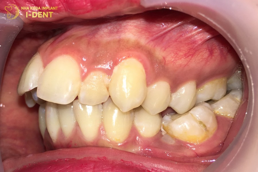 Hô răng hàm trên do yếu tố di truyền