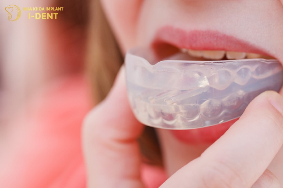 cách đeo niềng răng tại nhà