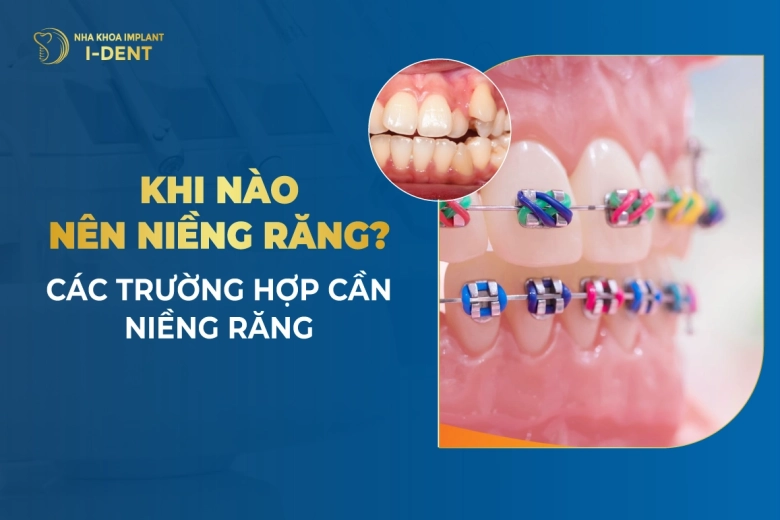 Khi nào nên niềng răng? Trường hợp và độ tuổi cần niềng