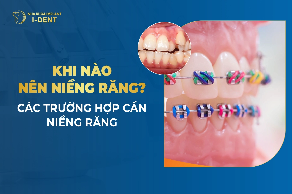 Khi nào nên niềng răng? Trường hợp và độ tuổi cần niềng