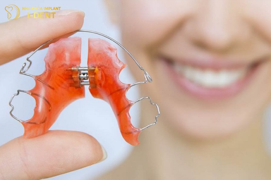 Không đeo hàm duy trì sau khi tháo niềng khiến răng bị hô trở lại