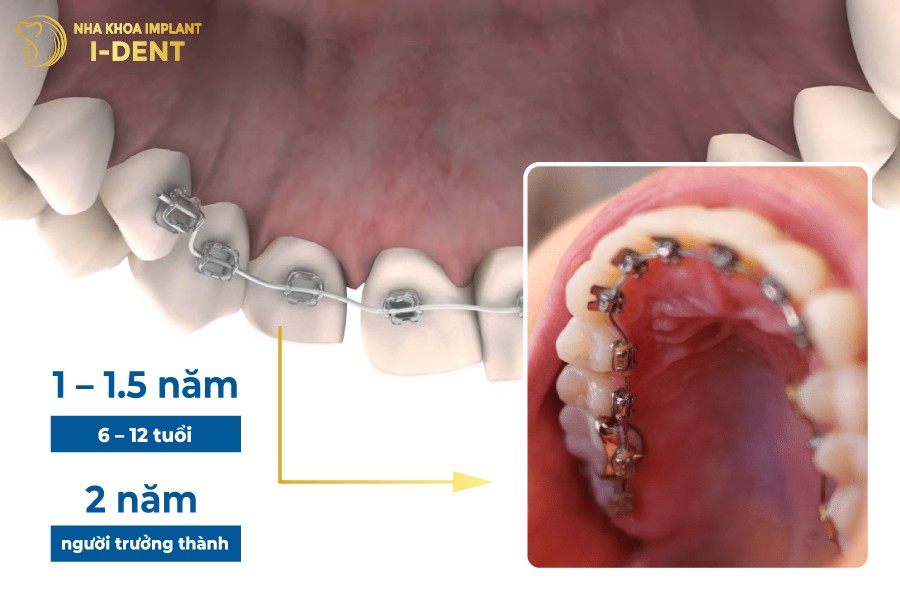 Khong-rut-ngan-thoi-gian-nieng-rang-tieu-chuan