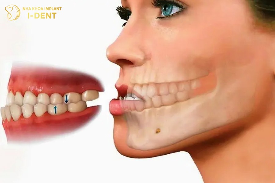 Khop-can-nguoc-do-rang-va-do-xuong-ham