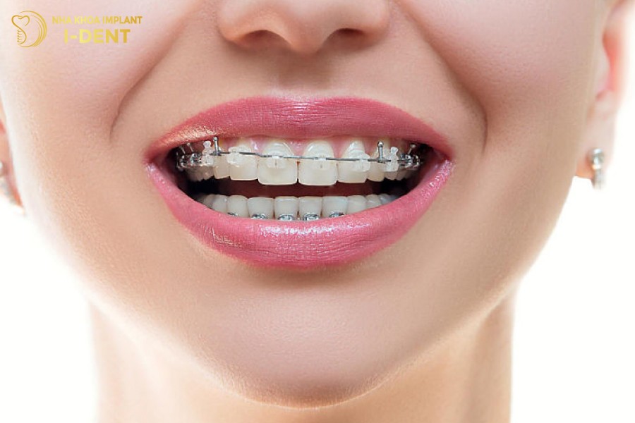 Khuon-mat-tro-nen-can-doi-hai-hoa-sau-khi-nieng-rang