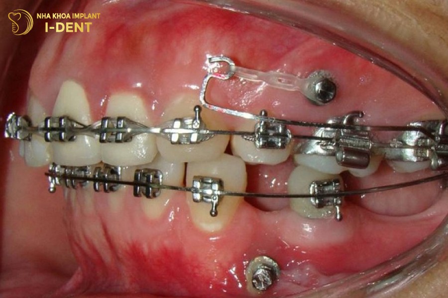 Mat-rang-vinh-vien-khi-nieng