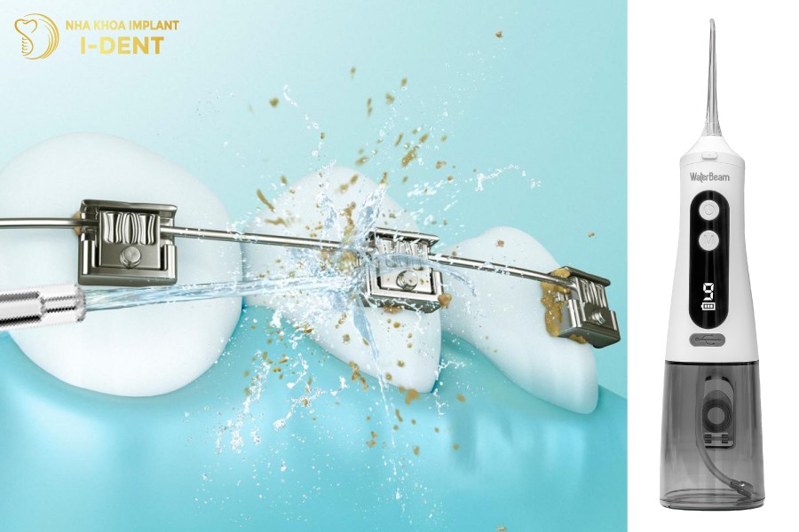 Máy tăm nước WaterBeam chuyên dụng cho răng niềng