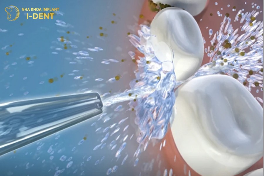 Máy tăm nước làm sạch răng hiệu quả nhờ sử dụng áp lực nước