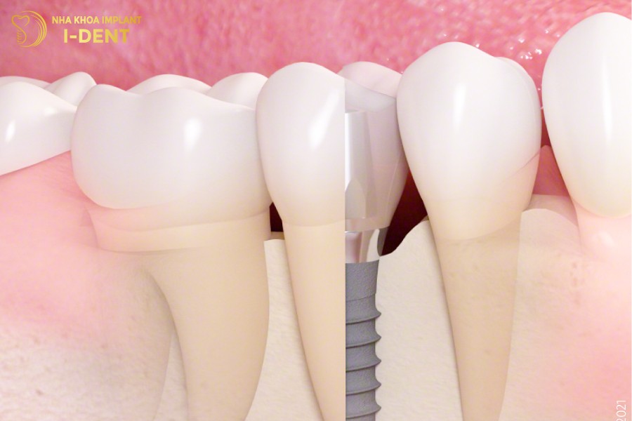 Mot-chiec-rang-Implant-hoan-chinh-co-tham-my-dep-khong-khac-gi-rang-that