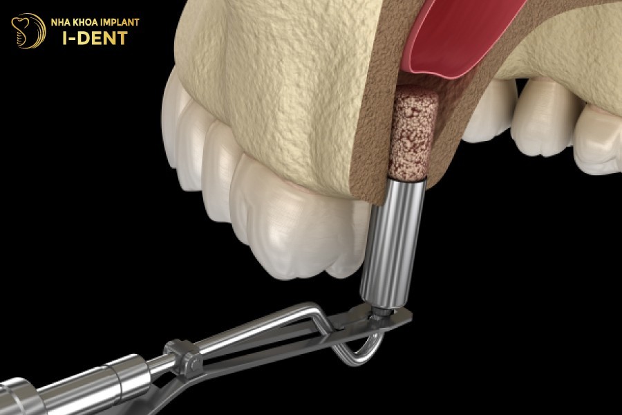 Nang-xoang-ham-khi-tieu-chan-rang