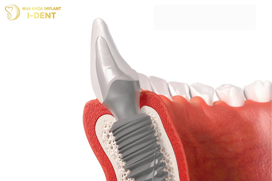 Nho-tinh-tuong-thich-sinh-hoc-tot-nen-tru-Titanium-de-dang-tich-hop-voi-xuong-ham.