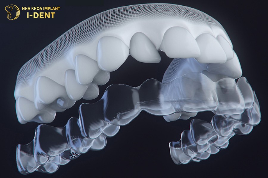 Niềng răng Invisalign