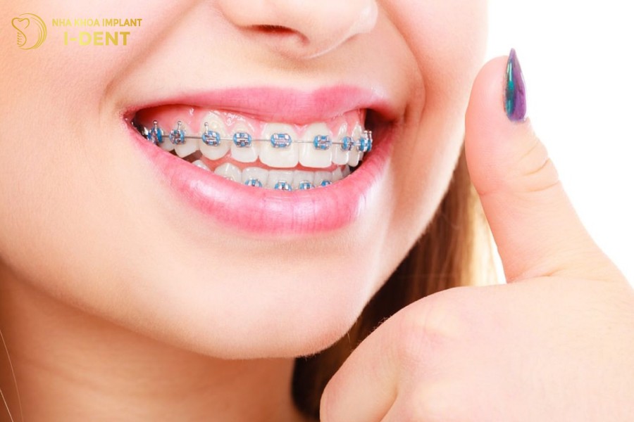 Niềng răng có giúp mũi cao lên không là thắc mắc của nhiều người