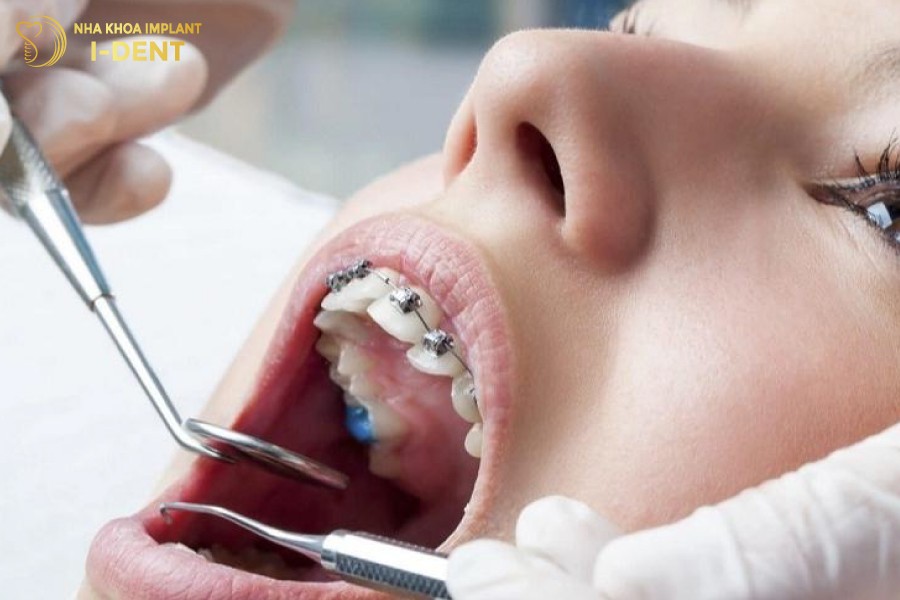 Nieng-rang-doi-hoi-su-ti-mi-va-do-chinh-xac-cao