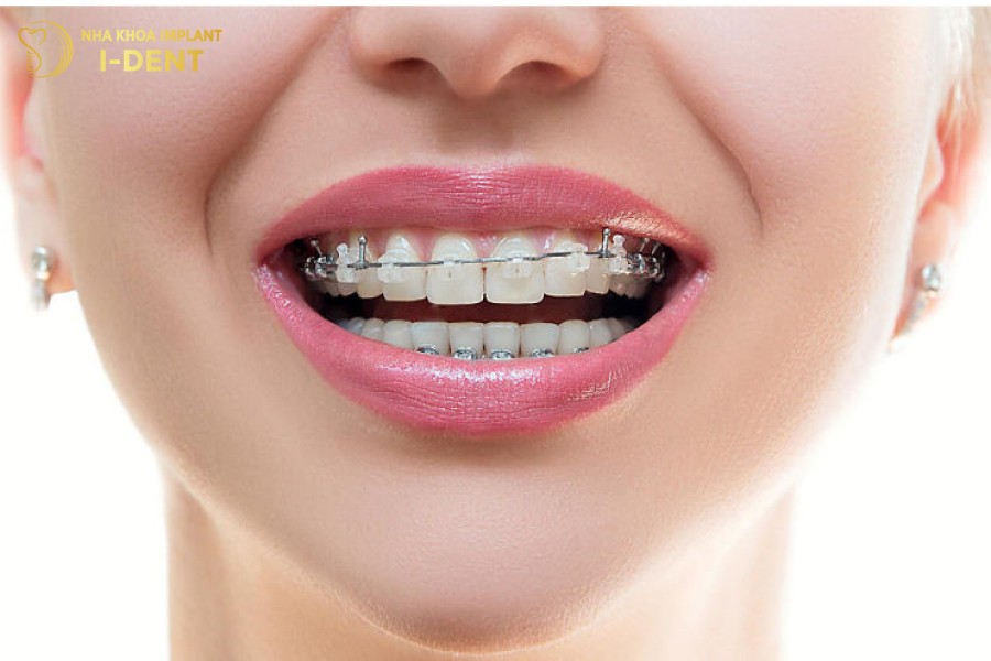 Nieng-rang-giup-khuon-mat-can-doi-hon