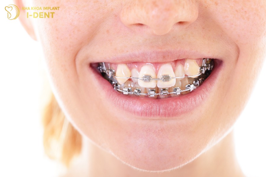Niềng răng hàm trên bằng mắc cài kim loại