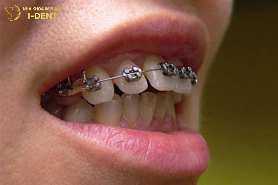 Niềng răng hô hàm trên