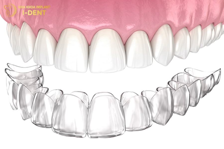 Nieng-rang-khong-mac-cai-Invisalign