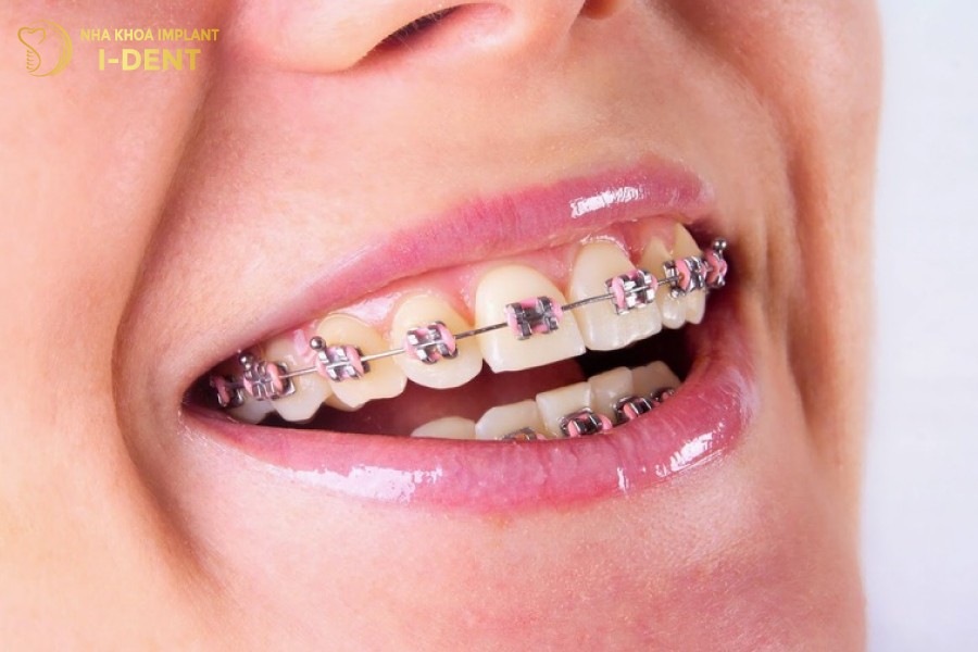 Nieng-rang-la-phuong-phap-chinh-nha-rat-hieu-qua