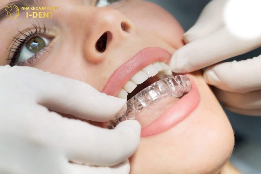 Niềng răng trong suốt có tính thẩm mỹ cao