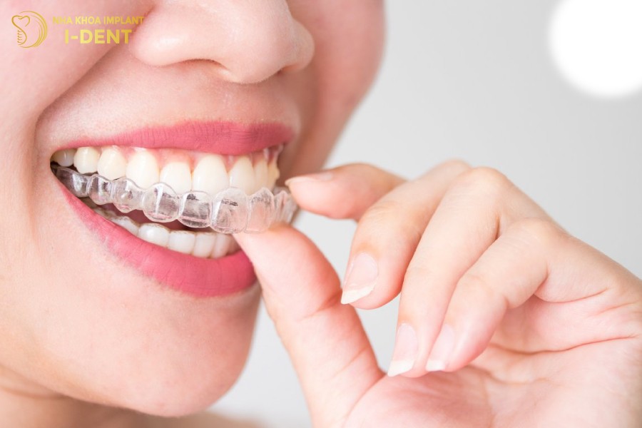 Niềng răng nhựa còn gọi là niềng răng trong suốt