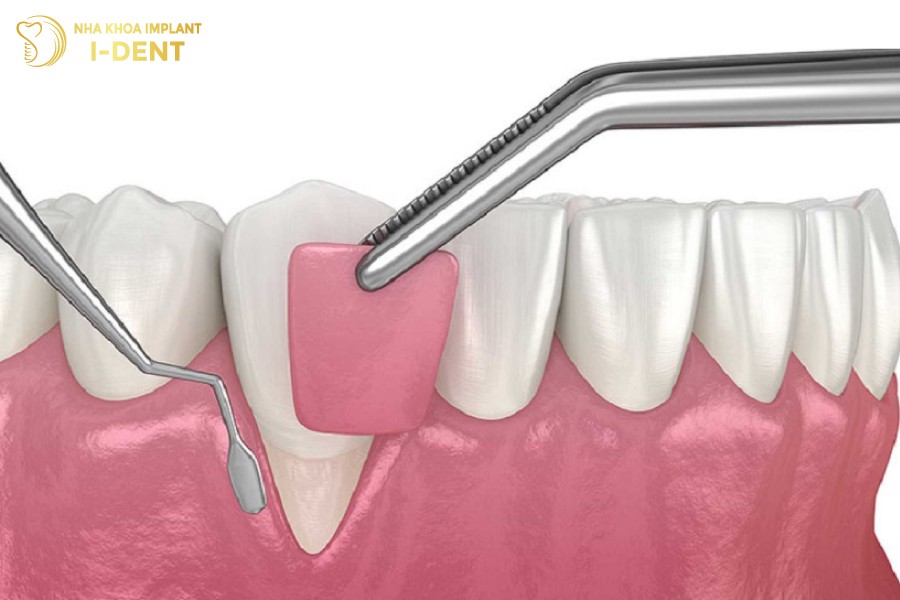 tụt nướu khi niềng răng