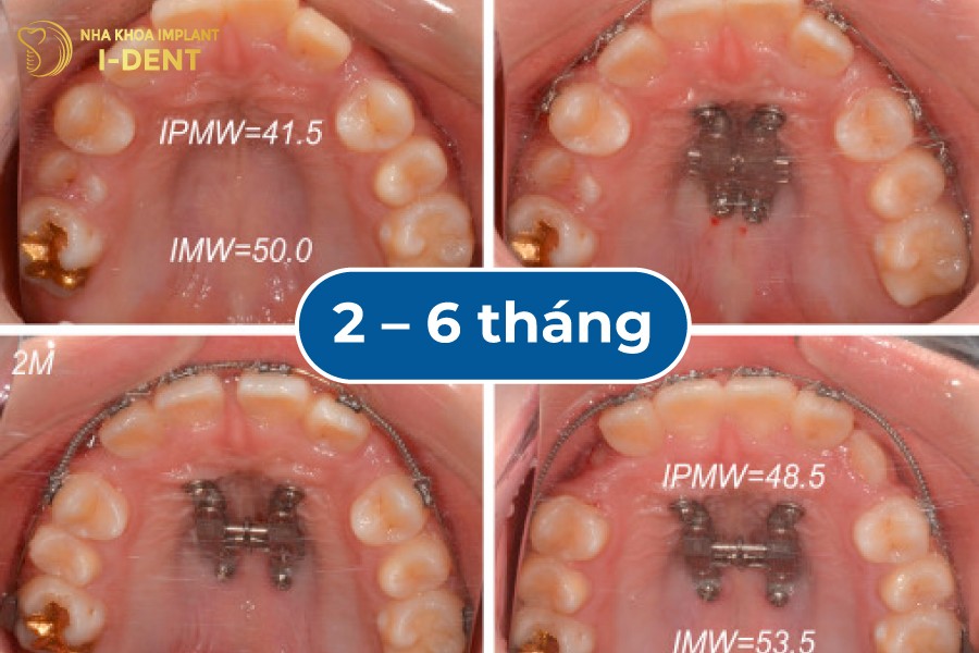 Qua-trinh-nong-ham-thuong-mat-tu-2-6-thang