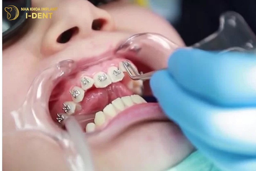 Răng sau niềng bị chạy ảnh hưởng lớn đến sức khỏe răng miệng