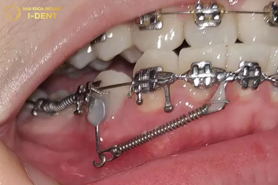 Su-dung-lo-xo-de-dong-khoang-trong-chinh-nha